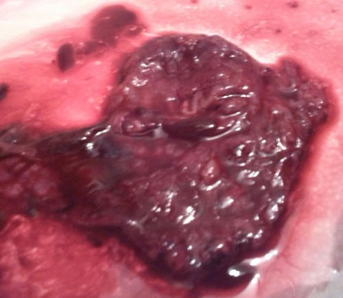 原始点成功助排子宫终止妊娠胎儿 原始点成功助排子宫终止妊娠胎儿