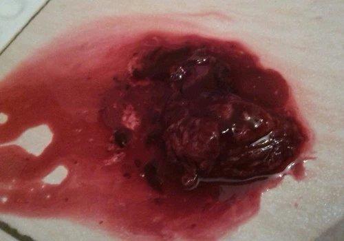 原始点成功助排子宫终止妊娠胎儿 原始点成功助排子宫终止妊娠胎儿