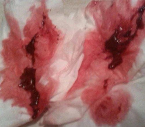 原始点成功助排子宫终止妊娠胎儿 原始点成功助排子宫终止妊娠胎儿