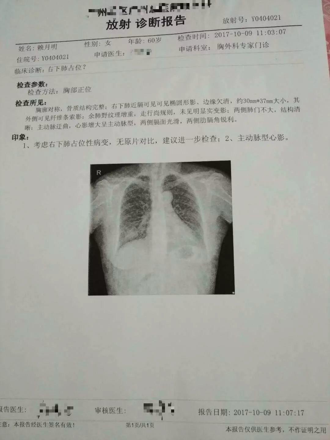 原始点调理肺部肿瘤:细节到位效果好 原始点调理肺部肿瘤:细节到位效果好