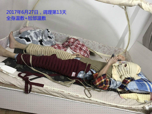 原始点调理严重湿疹:找回帅气的自己 原始点调理严重湿疹:找回帅气的自己