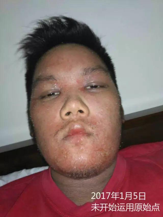 原始点调理23年严重湿疹:《21天的震撼》 原始点调理23年严重湿疹:《21天的震撼》