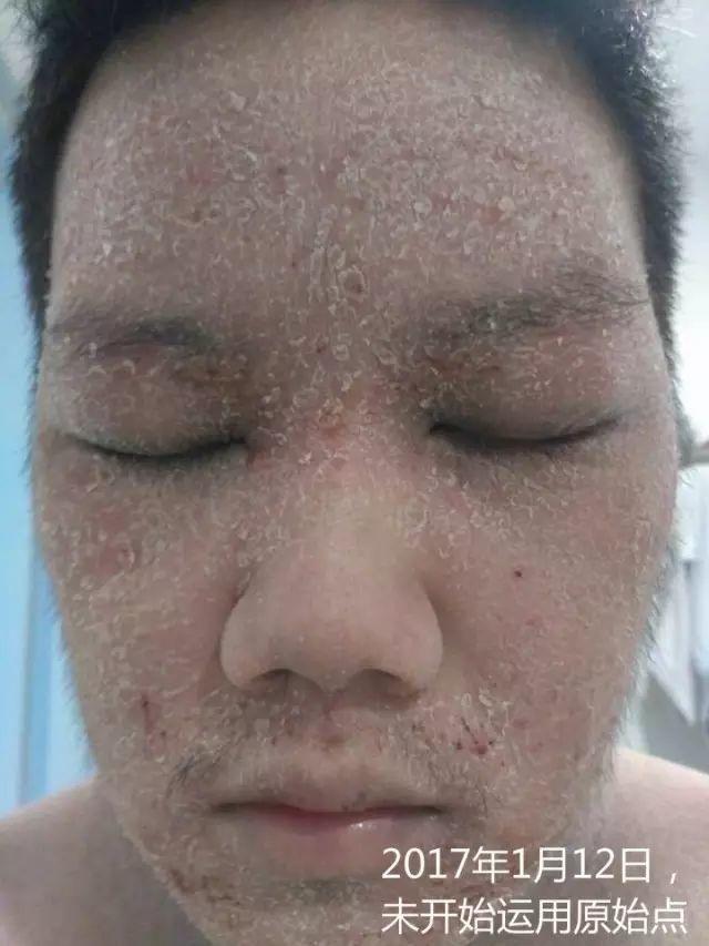 原始点调理23年严重湿疹:《21天的震撼》 原始点调理23年严重湿疹:《21天的震撼》