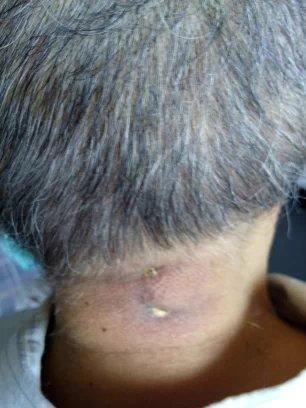 十几年对口疮  原始点调理27天康复