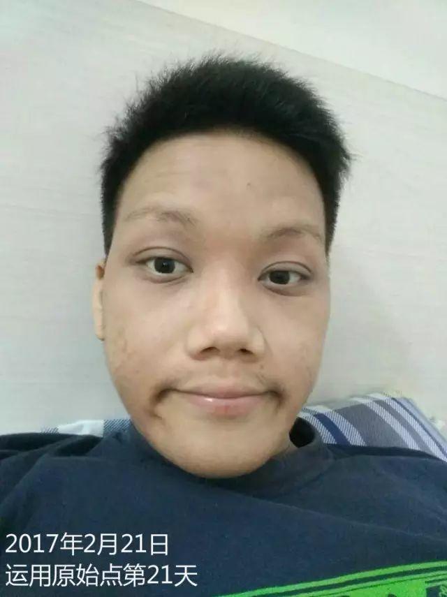 原始点调理23年严重湿疹:《21天的震撼》 原始点调理23年严重湿疹:《21天的震撼》