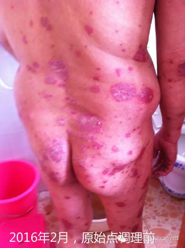 触目惊心  原始点调理八年病史牛皮癣，半年基本恢复健康