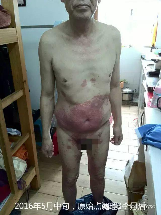 触目惊心  原始点调理八年病史牛皮癣，半年基本恢复健康