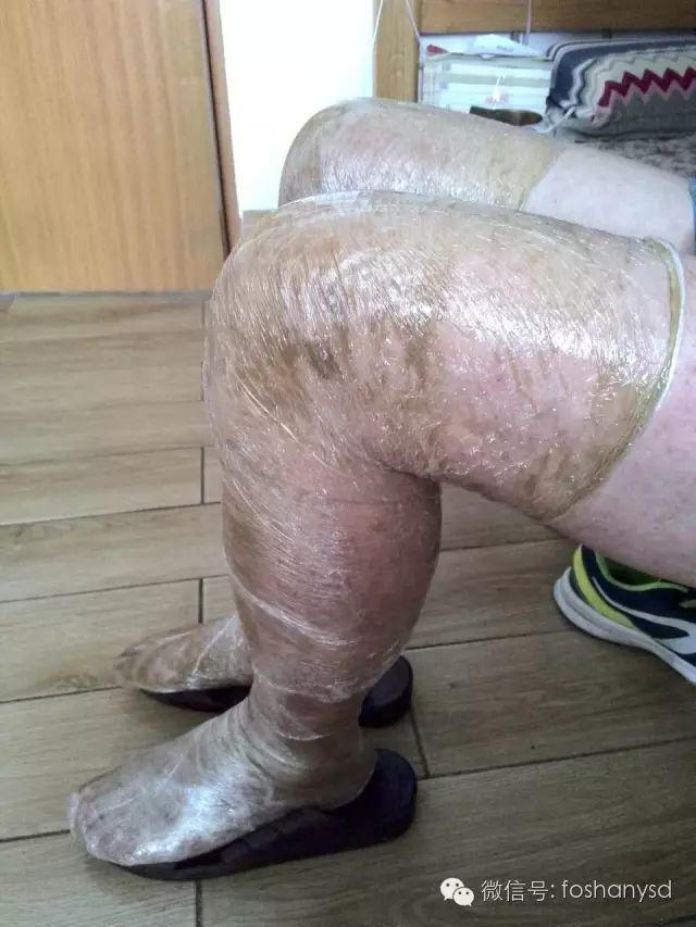 触目惊心  原始点调理八年病史牛皮癣，半年基本恢复健康