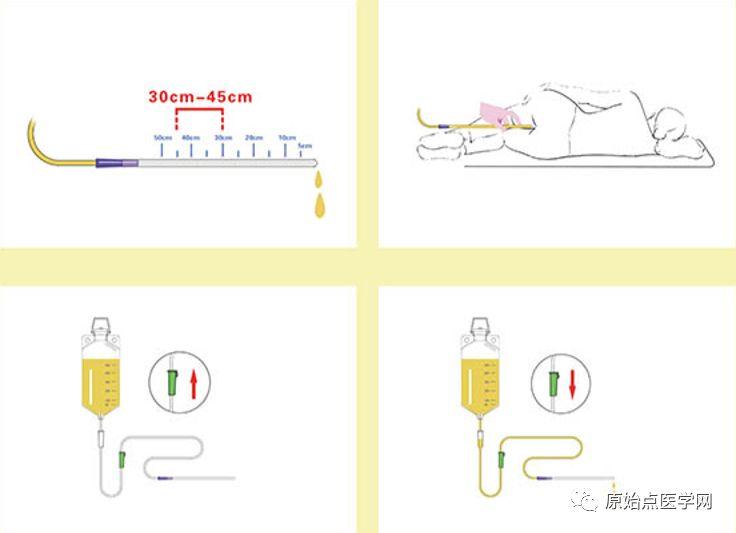 精华汇总 | 原始点医学之姜的应用(新增灌肠部分)201808第13版 精华汇总 | 原始点医学之姜的应用(新增灌肠部分)201808第13版