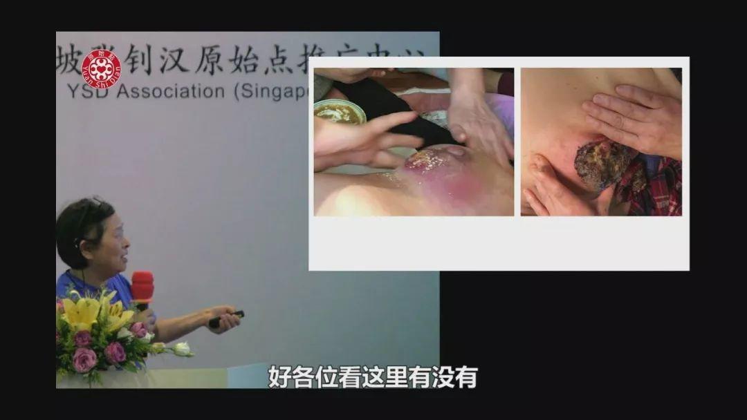 乳癌案例（旧金山）