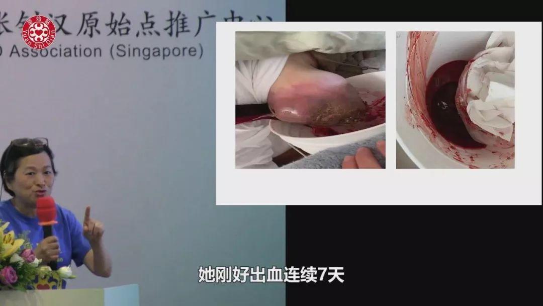 乳癌案例(2)-红肿胀痛储出血(纽约)