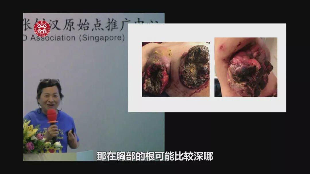 乳癌案例（旧金山）