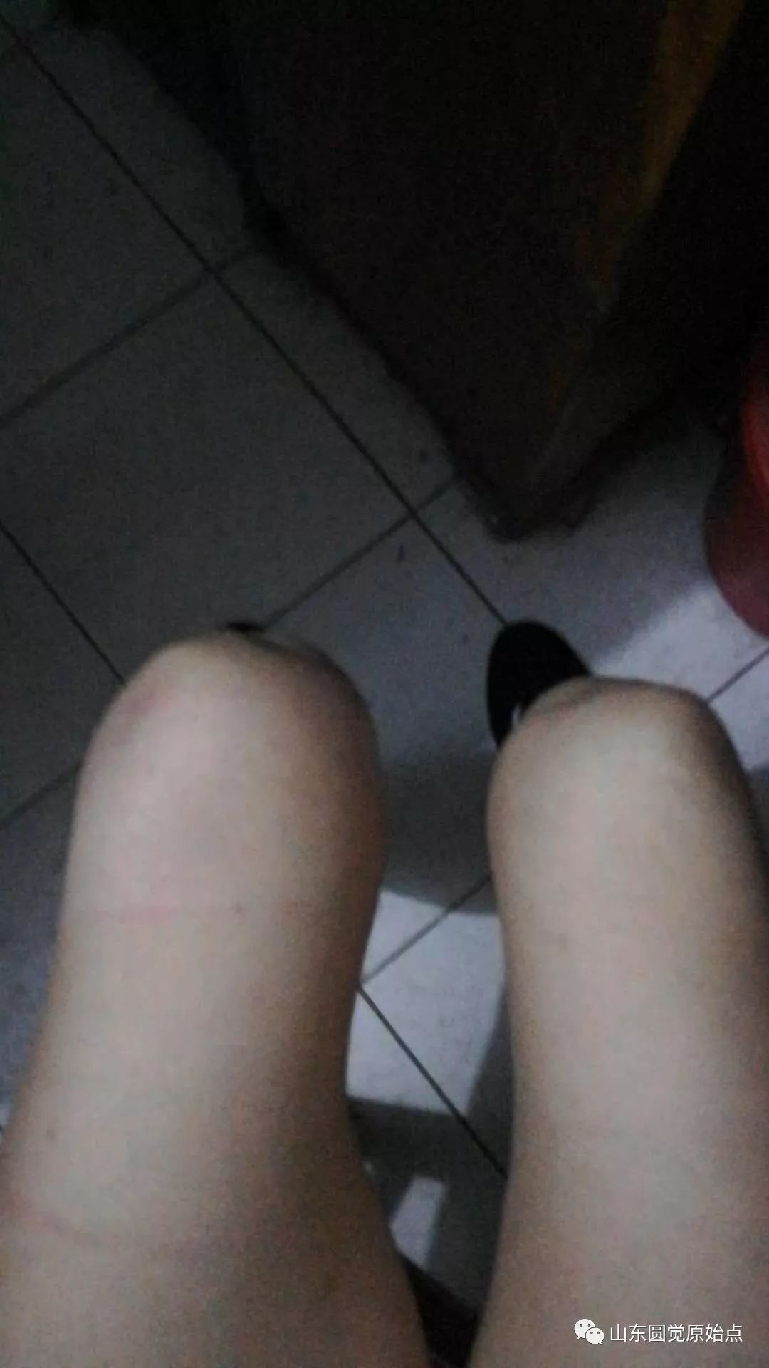 原始点案例:膝盖肿胀-原始点全球同学网