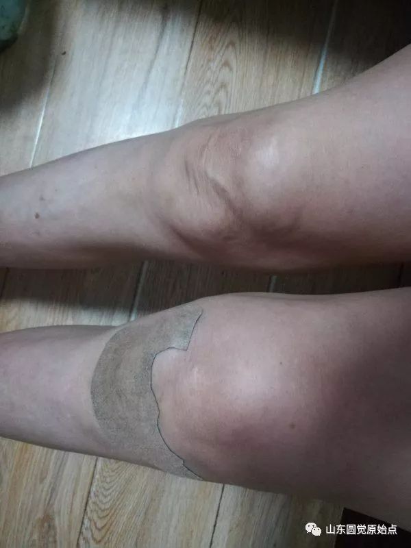 原始点案例:膝盖肿胀 原始点案例:膝盖肿胀
