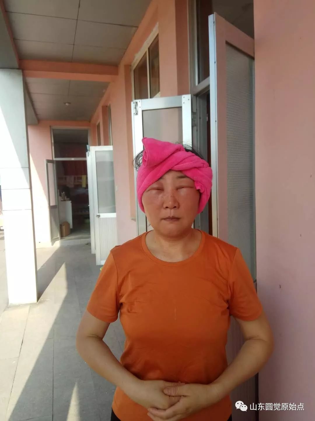 山东原始点案例:化妆品过敏脸部浮肿 山东原始点案例:化妆品过敏脸部浮肿