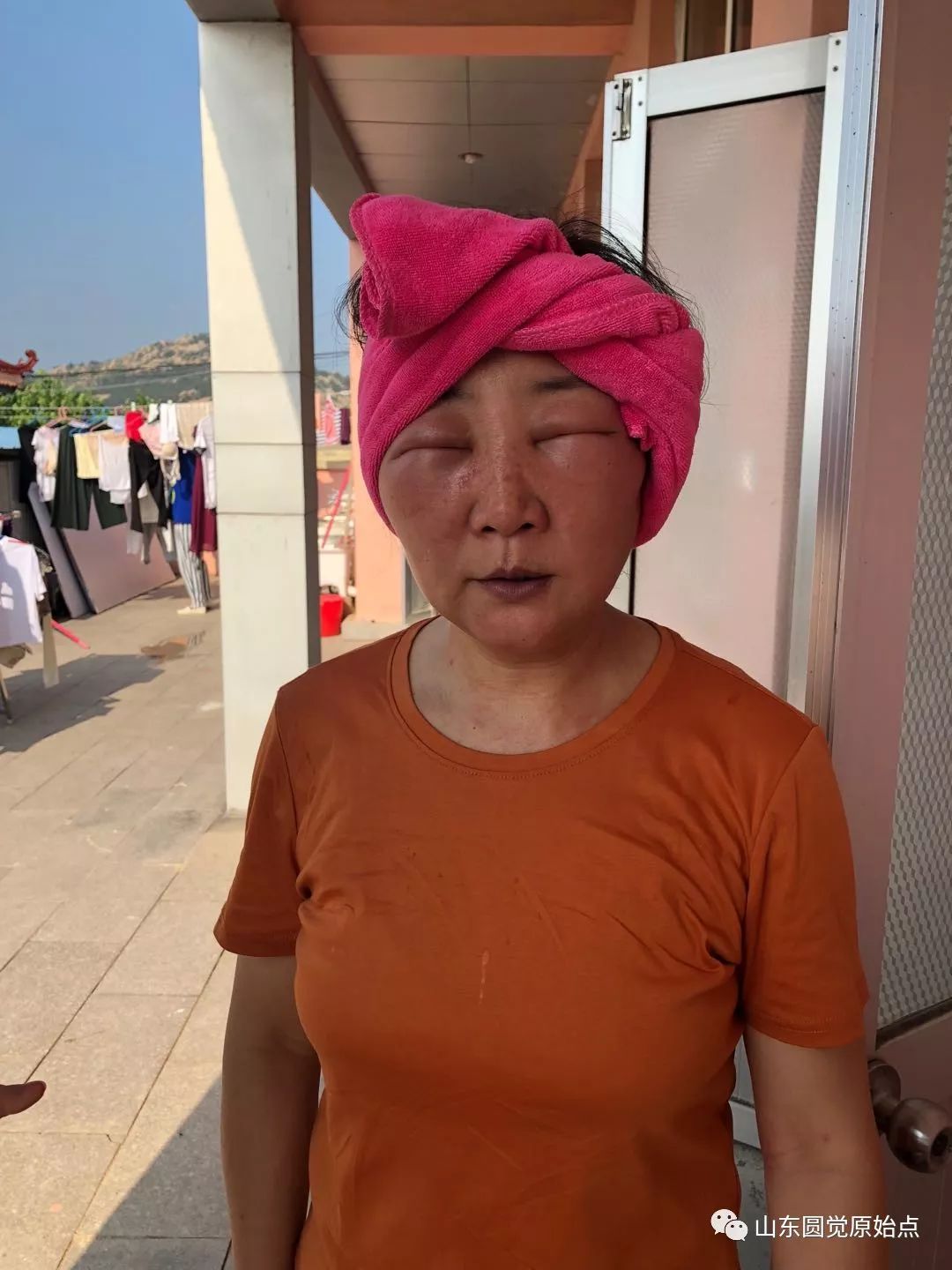 山东原始点案例:化妆品过敏脸部浮肿 山东原始点案例:化妆品过敏脸部浮肿