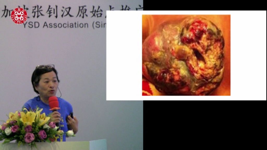 乳癌肿瘤处理 乳癌肿瘤处理