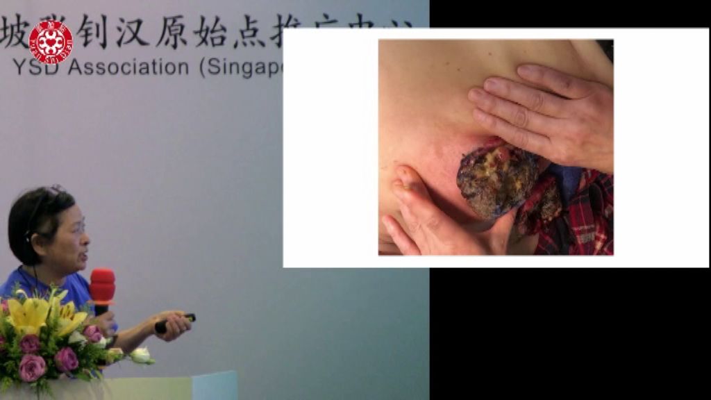 乳癌肿瘤处理 乳癌肿瘤处理