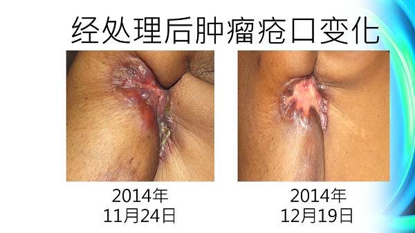 乳癌案例(若斯玲)(简体版) 乳癌案例(若斯玲)(简体版)