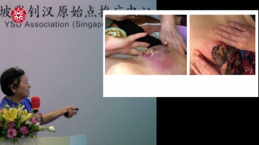 乳癌肿瘤处理 乳癌肿瘤处理