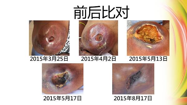 82岁婆婆乳癌案例（简体版）