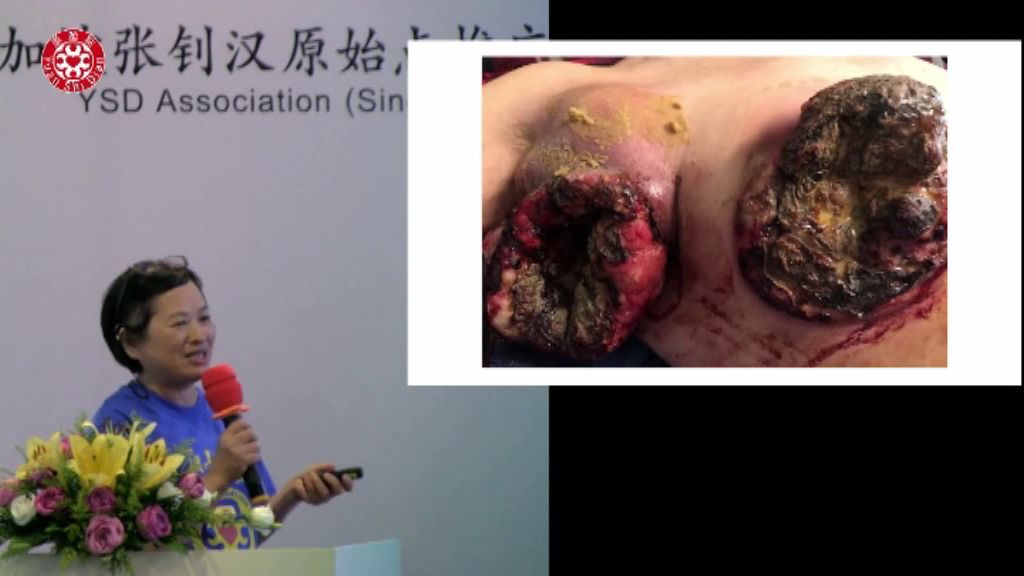 乳癌肿瘤处理 乳癌肿瘤处理