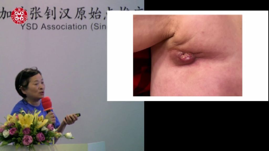 乳癌肿瘤处理 乳癌肿瘤处理