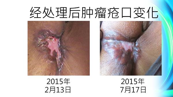 乳癌案例(若斯玲)(简体版) 乳癌案例(若斯玲)(简体版)