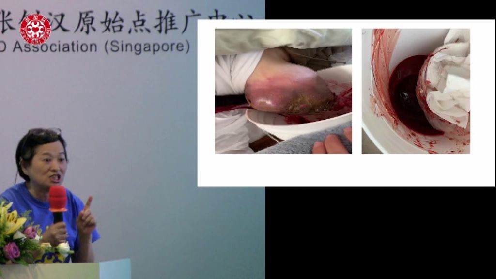 乳癌肿瘤处理 乳癌肿瘤处理