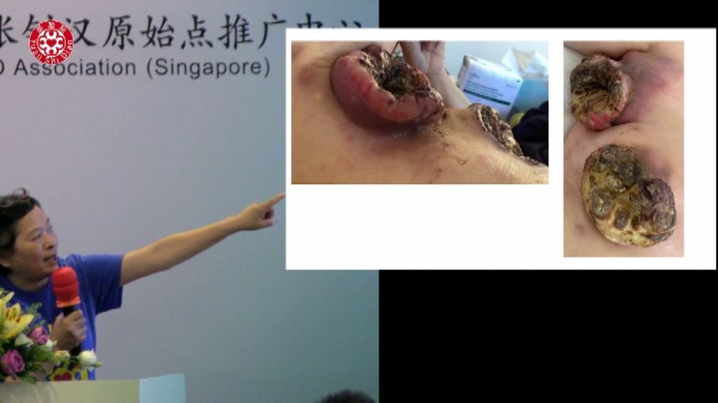 乳癌肿瘤处理 乳癌肿瘤处理