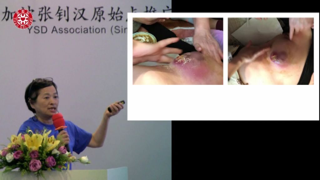 乳癌肿瘤处理 乳癌肿瘤处理