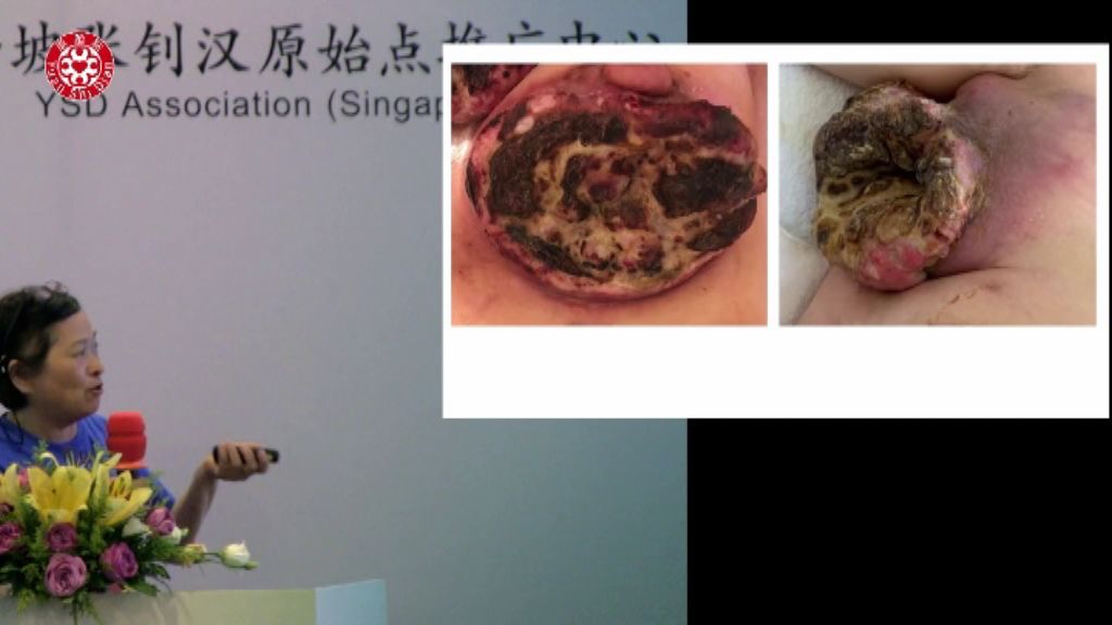 乳癌肿瘤处理 乳癌肿瘤处理