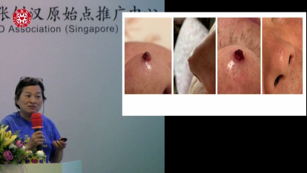 乳癌肿瘤处理 乳癌肿瘤处理