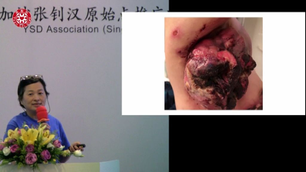 乳癌肿瘤处理 乳癌肿瘤处理