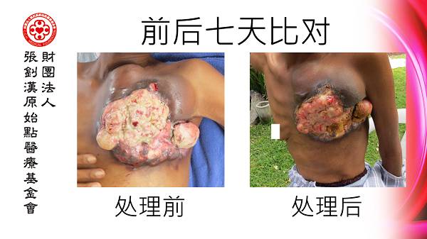 乳癌七天大幅改善案例(46岁辛巴威)(简体版) 乳癌七天大幅改善案例(46岁辛巴威)(简体版)