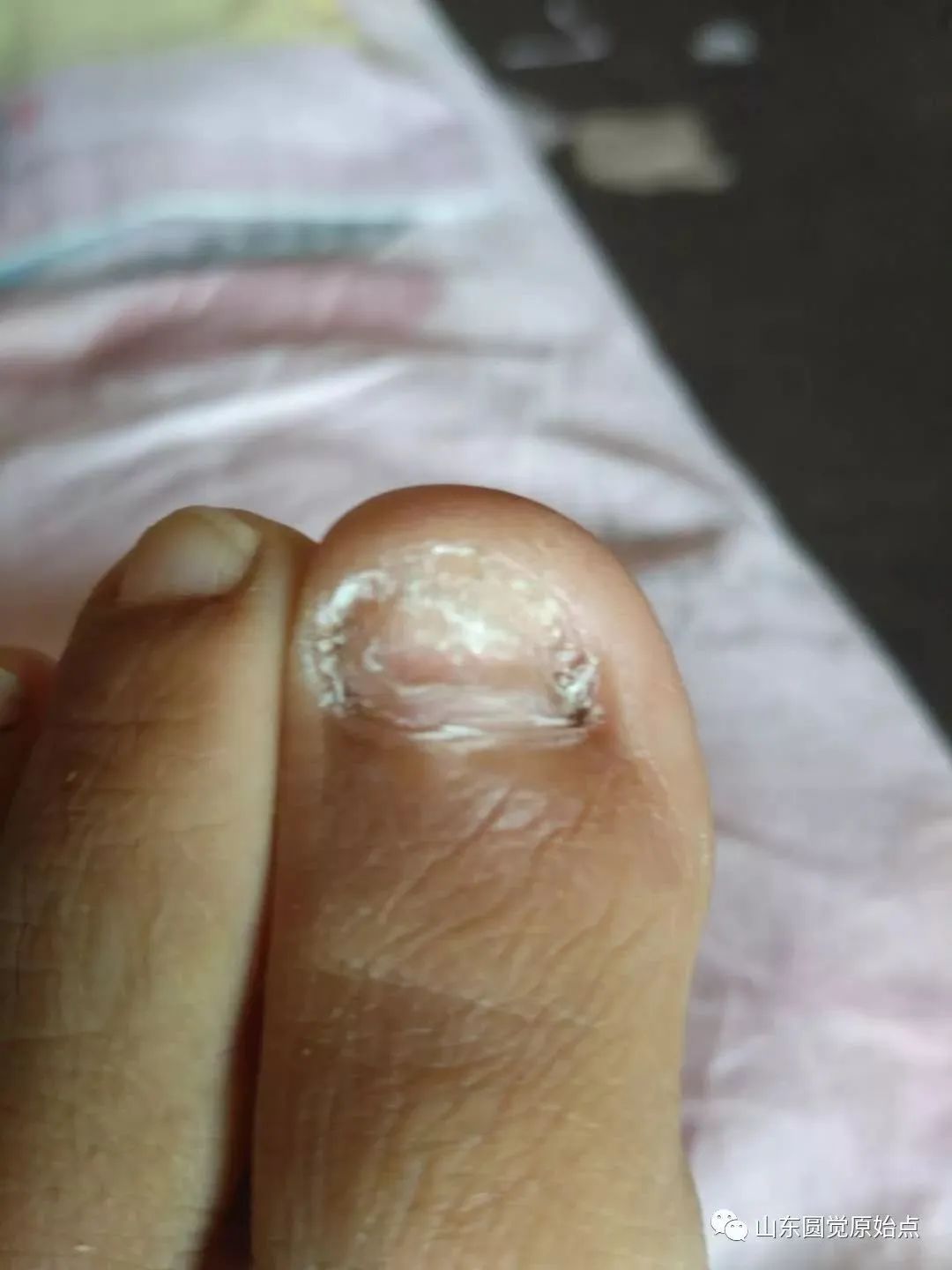 原始点案例：处理灰指甲