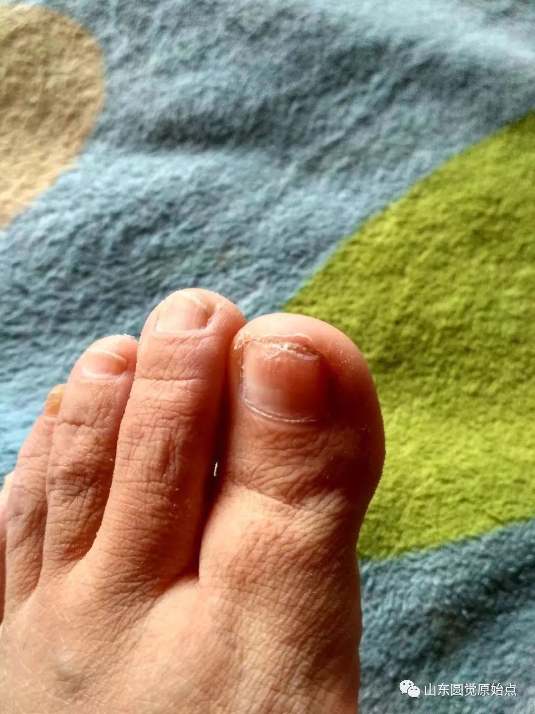 原始点案例：处理灰指甲