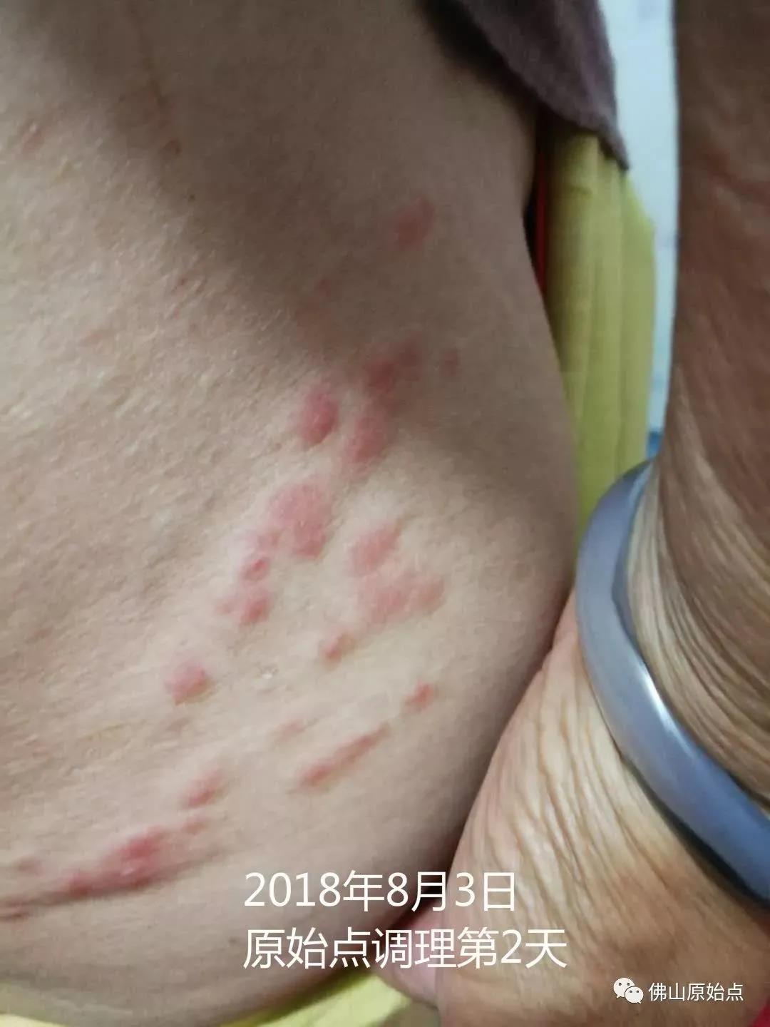 顾女士66岁新疆伊宁市开发区 调理带状疱疹：又快又彻底 2018年9月-原始点全球同学网