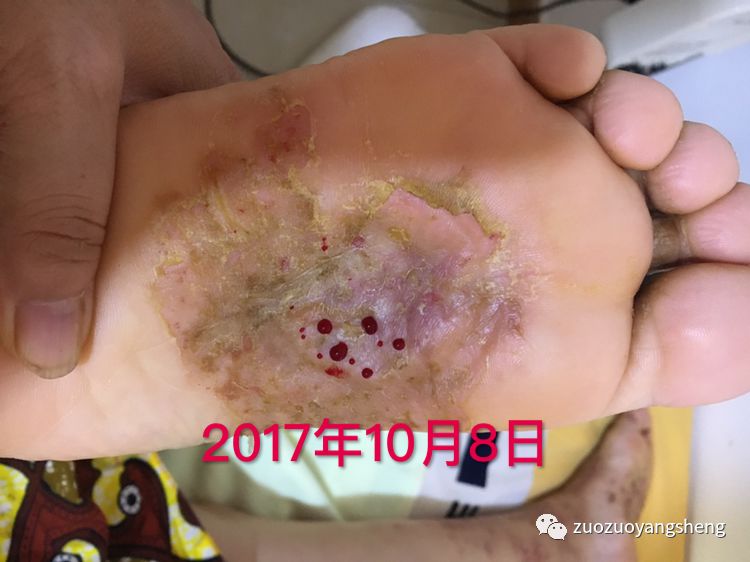 案例分享:原始点调理全身奇痒无比的湿疹案例 案例分享:原始点调理全身奇痒无比的湿疹案例