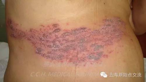 案例分享:原始点调理带状疱疹的案例 案例分享:原始点调理带状疱疹的案例
