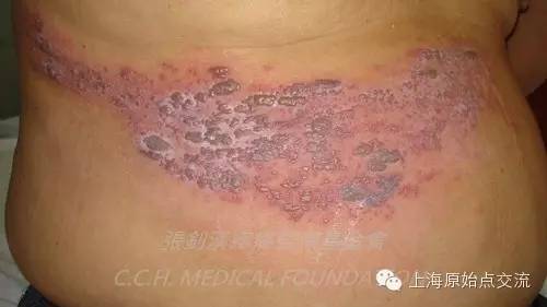 案例分享:原始点调理带状疱疹的案例 案例分享:原始点调理带状疱疹的案例