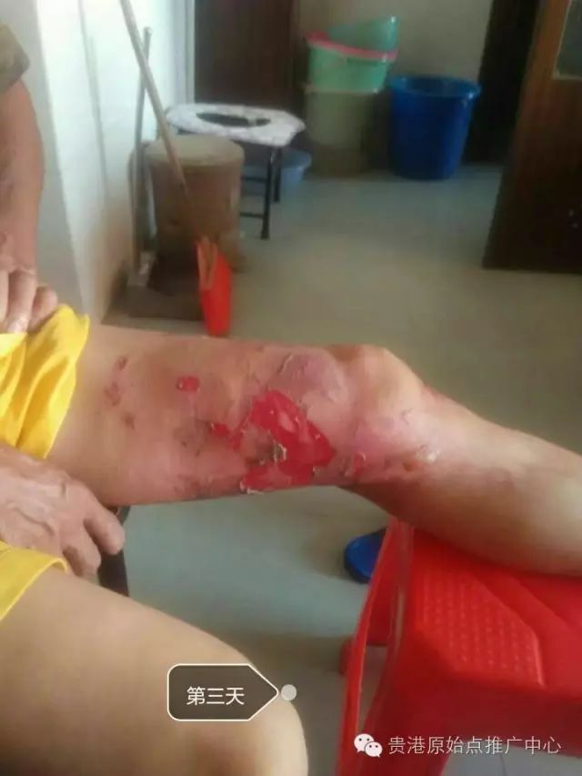 案例分享:原始点调理车祸烧伤不留疤的案例 案例分享:原始点调理车祸烧伤不留疤的案例