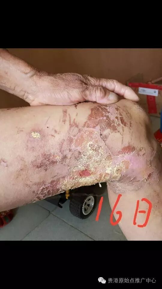 案例分享:原始点调理车祸烧伤不留疤的案例 案例分享:原始点调理车祸烧伤不留疤的案例