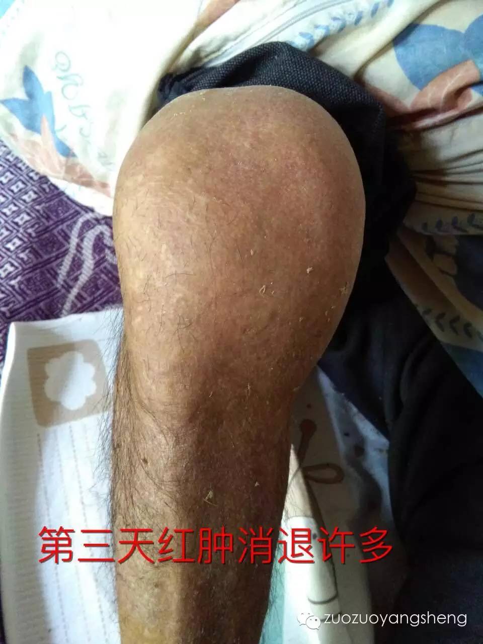 案例分享：原始点调理类风湿五天改善的案例