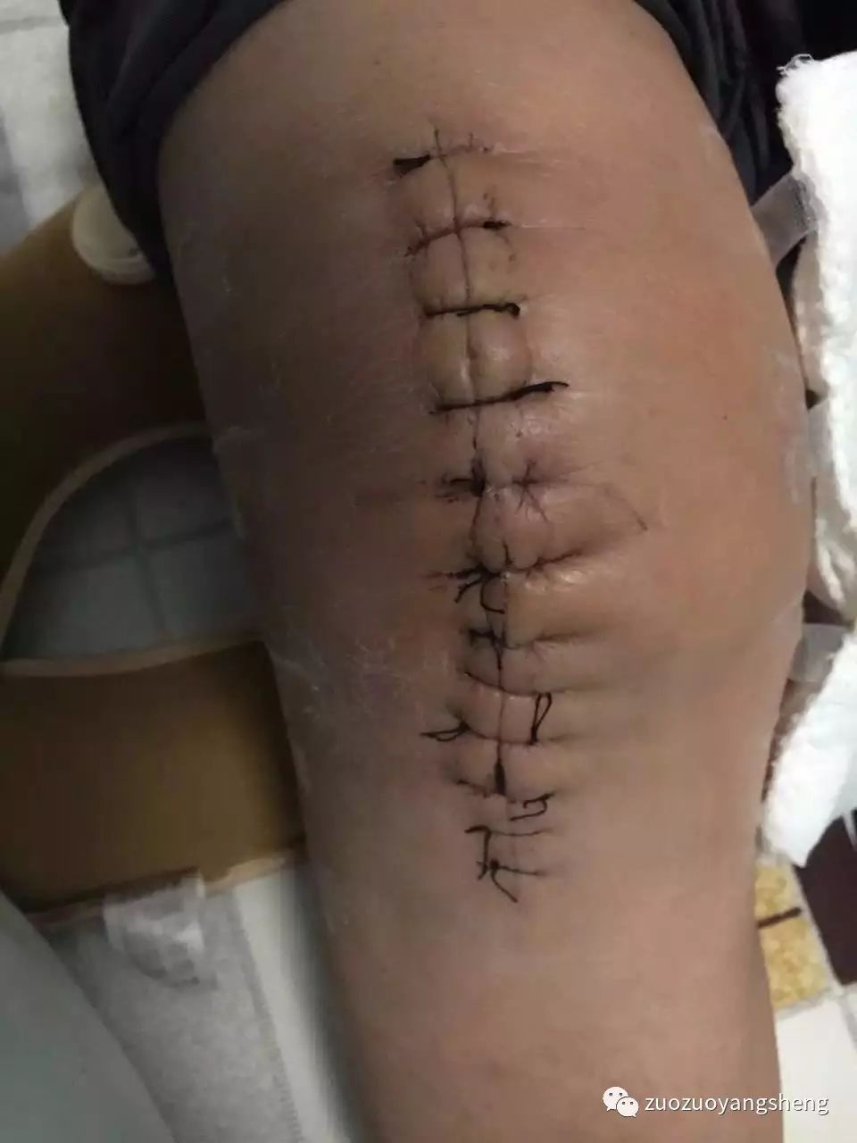 案例分享:最难度的家人——原始点调理妈妈骨折手术后的康复 案例分享:最难度的家人——原始点调理妈妈骨折手术后的康复