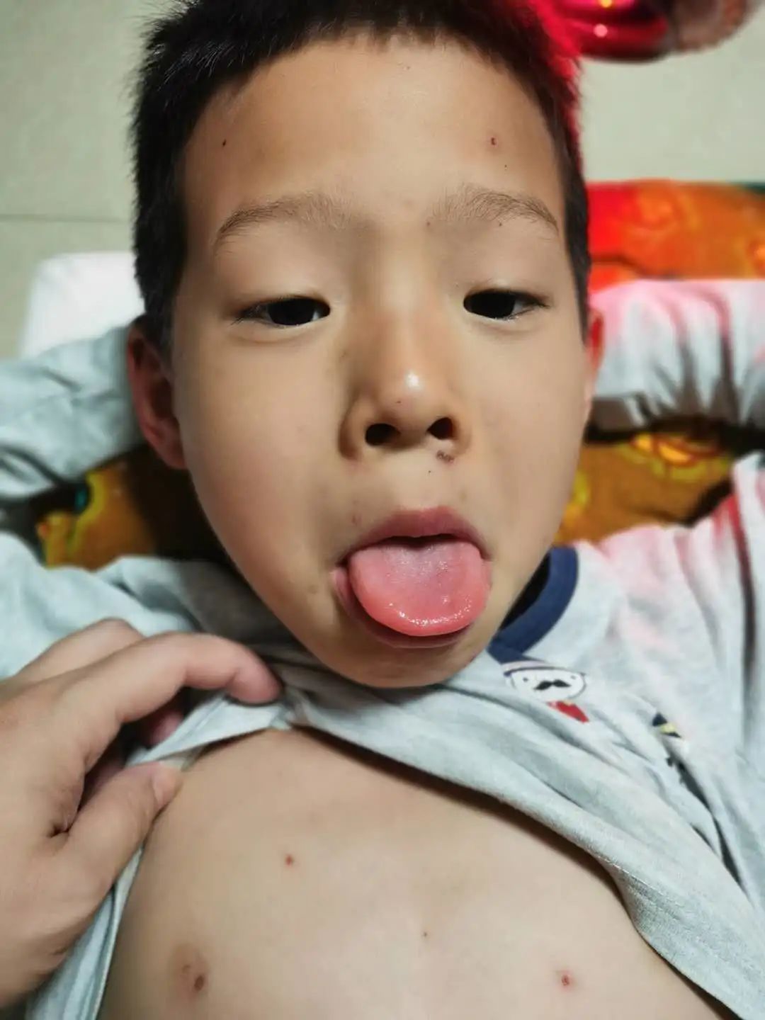 案例分享:原始点调理孩子水痘案例 案例分享:原始点调理孩子水痘案例