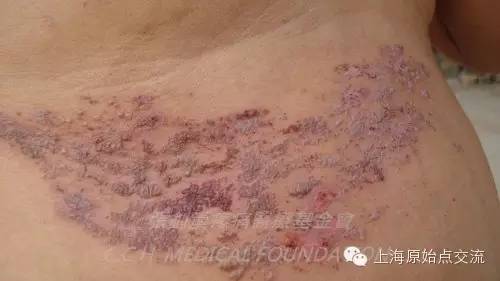 案例分享:原始点调理带状疱疹的案例 案例分享:原始点调理带状疱疹的案例