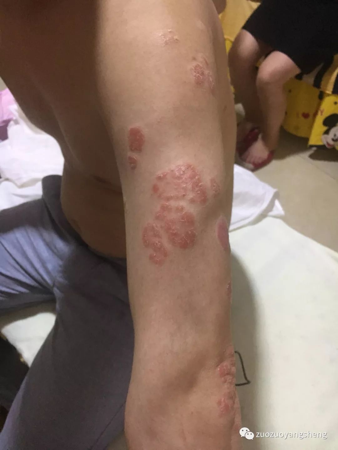 案例分享:原始点调理十几年牛皮癣的案例 案例分享:原始点调理十几年牛皮癣的案例