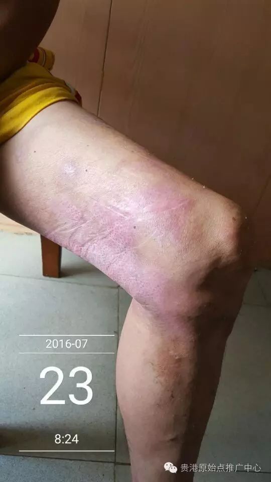 案例分享:原始点调理车祸烧伤不留疤的案例 案例分享:原始点调理车祸烧伤不留疤的案例