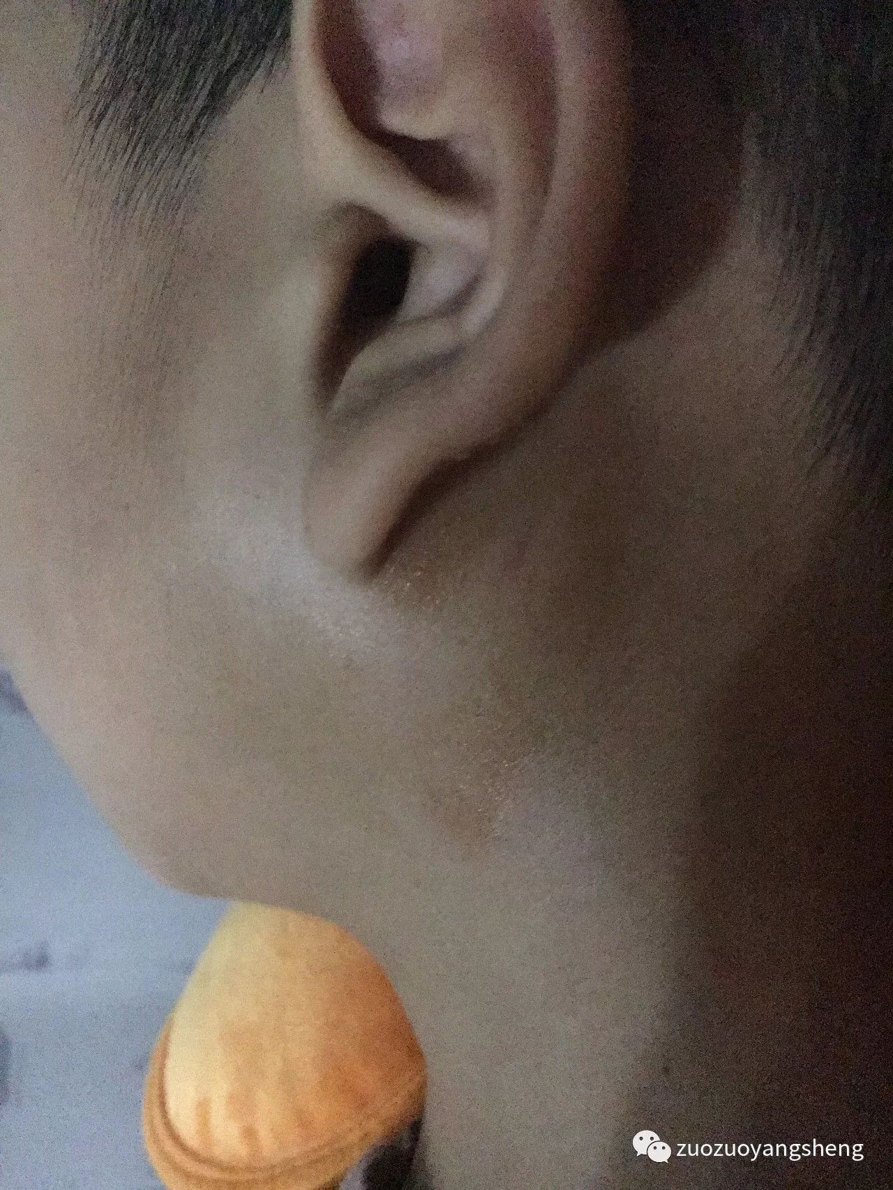 案例分享：原始点调理儿子的腮腺炎